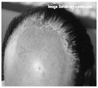 Image of Psoriasis Hair