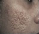  Remove Acne Pimples Scar