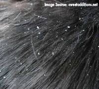 Hair With Dandruff Problem