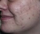 Acne Scar On Face 